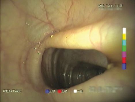 The image shows an endoscopic view from inside a body with moist, yellowish illuminated tissue and fine blood vessels along the wall. In the center there is a dark, elongated structure with ring-like ridges, and camera overlays and scales from a medical device appear along the edges.