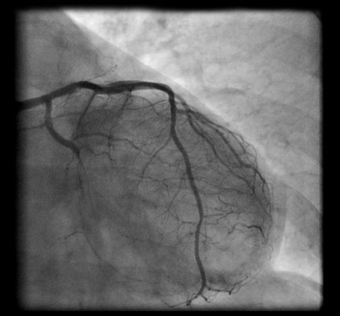 Black-and-white X-ray image of showing coronary arteries.